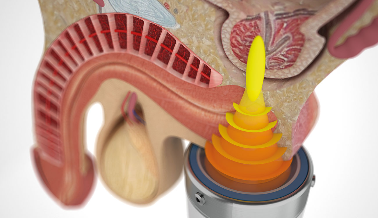 CPPS Treatment