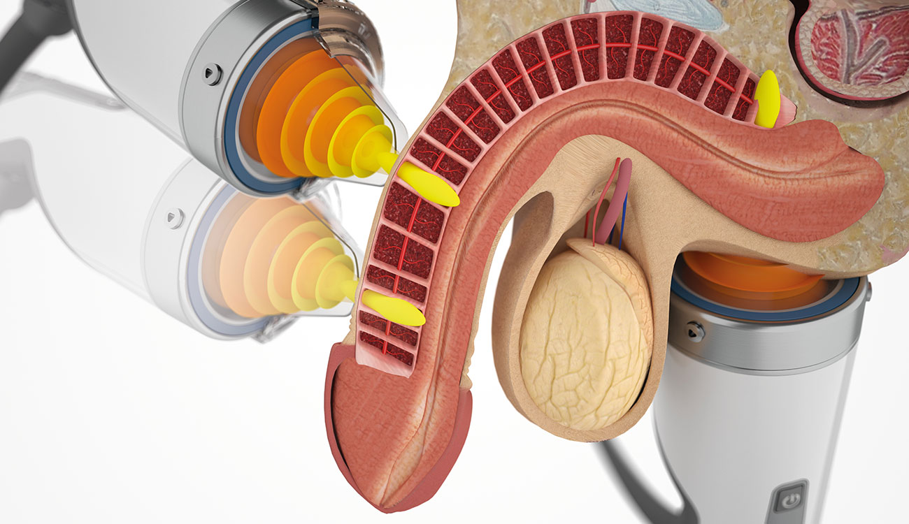 IPP Treatment