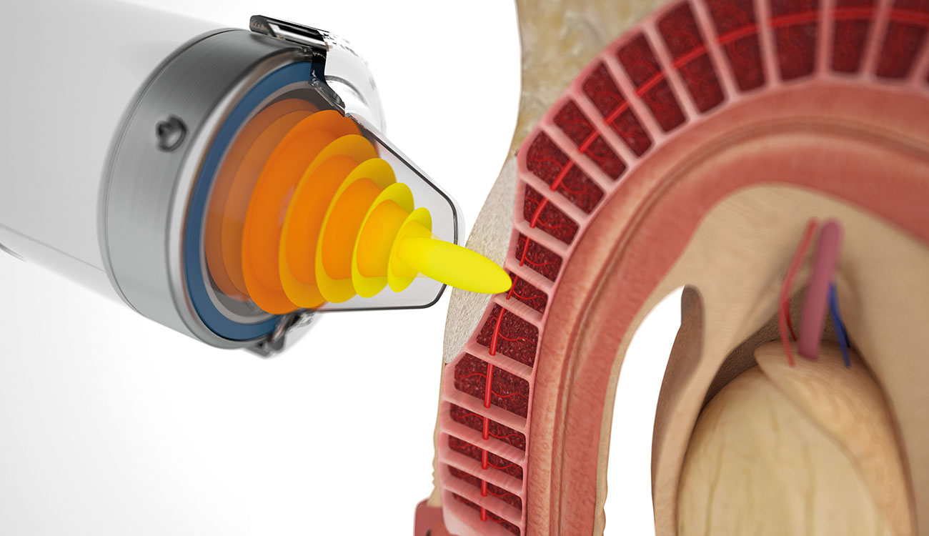 Erectile Dysfunction Treatment
