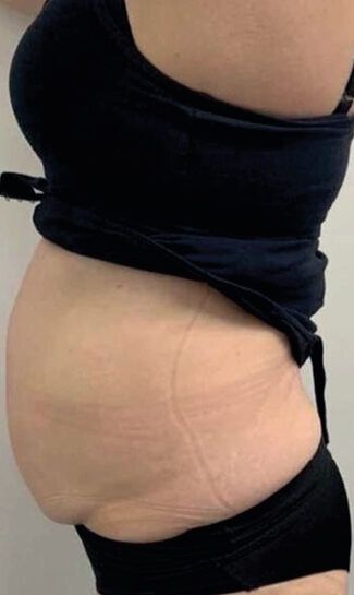 Body Shaping Results